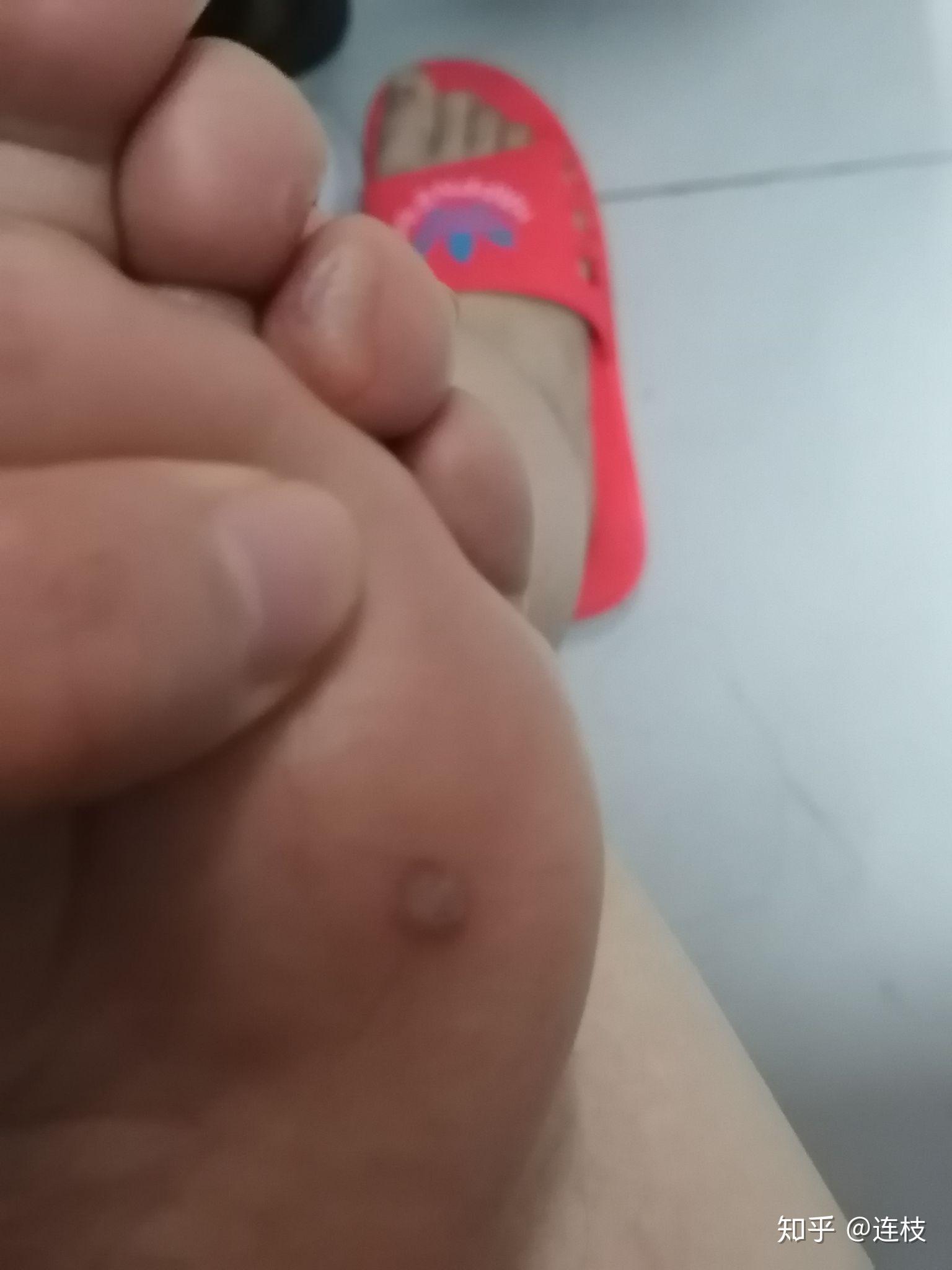 怎么弄水泡 v2-83fa88beaa4a89da08860e4eacd42fb3_r.jpg