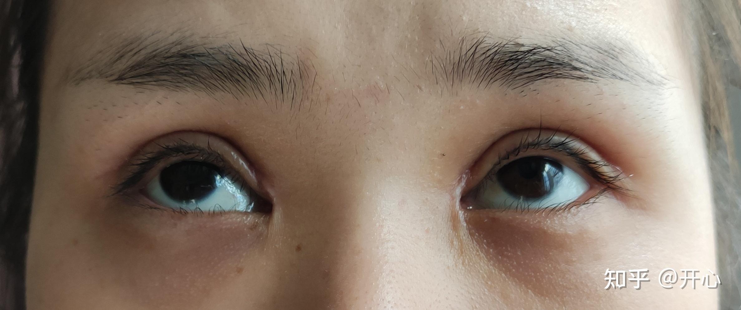 双眼皮开眼角增生疤痕能修复吗？ - 知乎