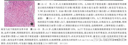四肢多形性未分化肉瘤
