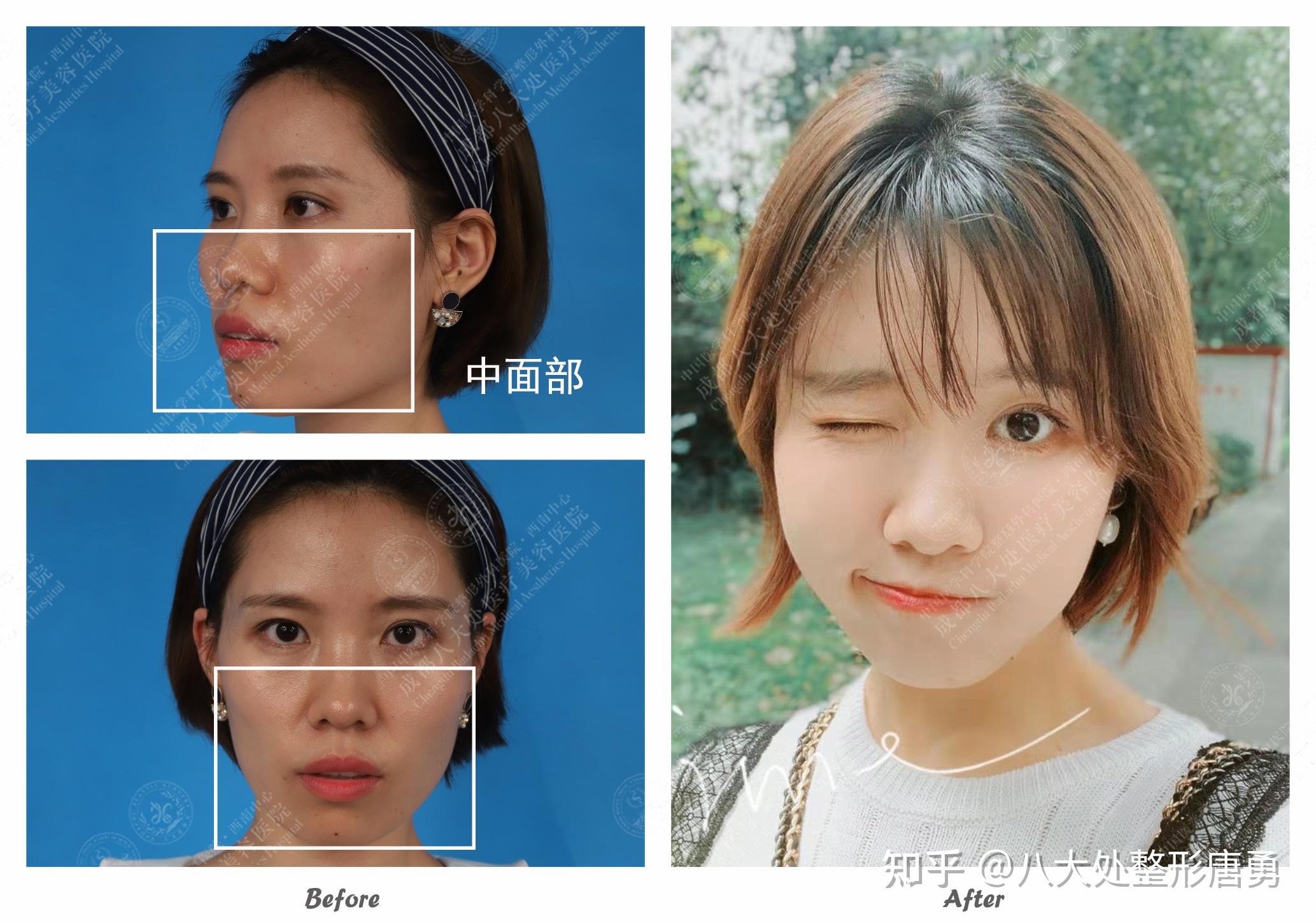 自体脂肪填充:加法的填充,减法的效果(含案例) - 知乎