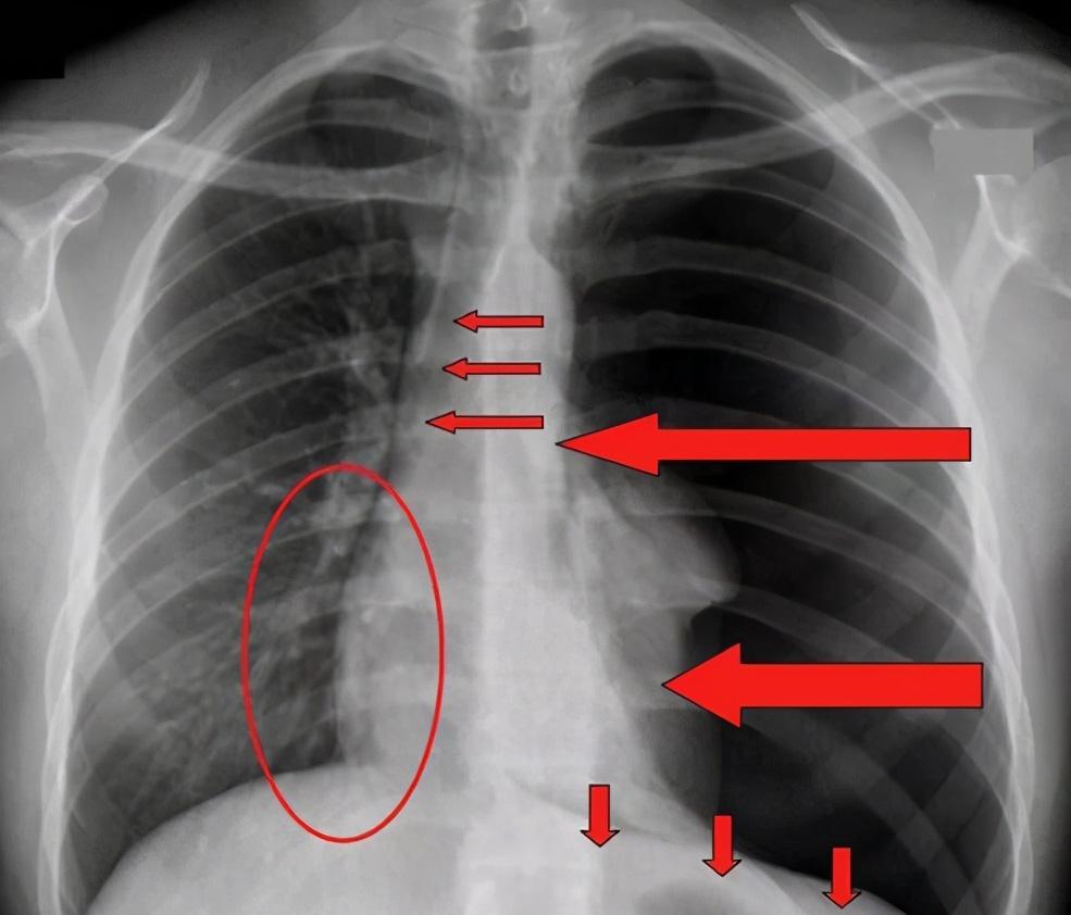 肺门x线图片图片