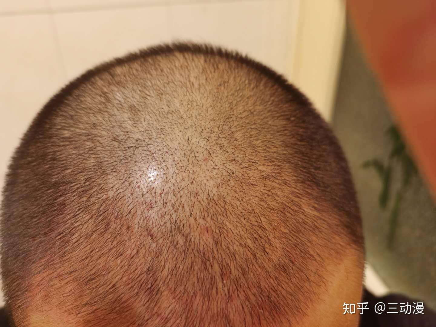 植发手术后期(植发手术后期怎么护理)