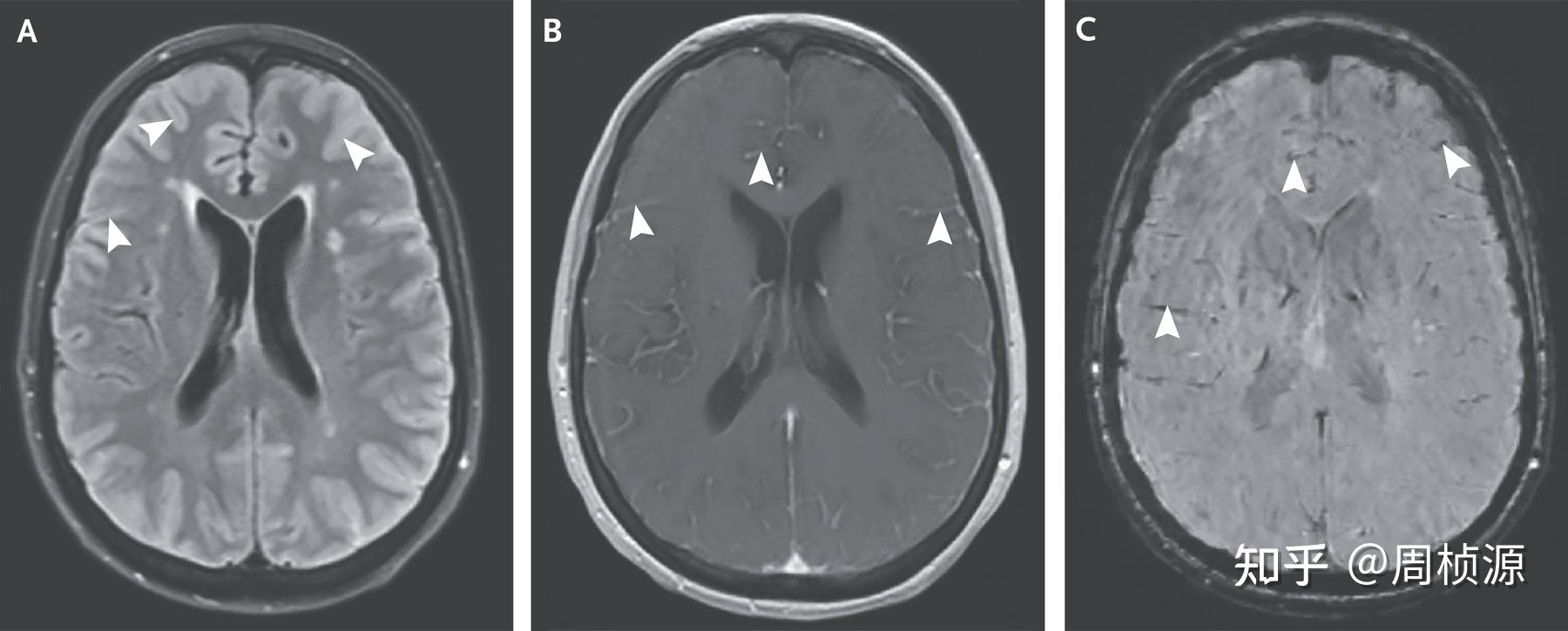 Nejm 2021 Case 22 知乎