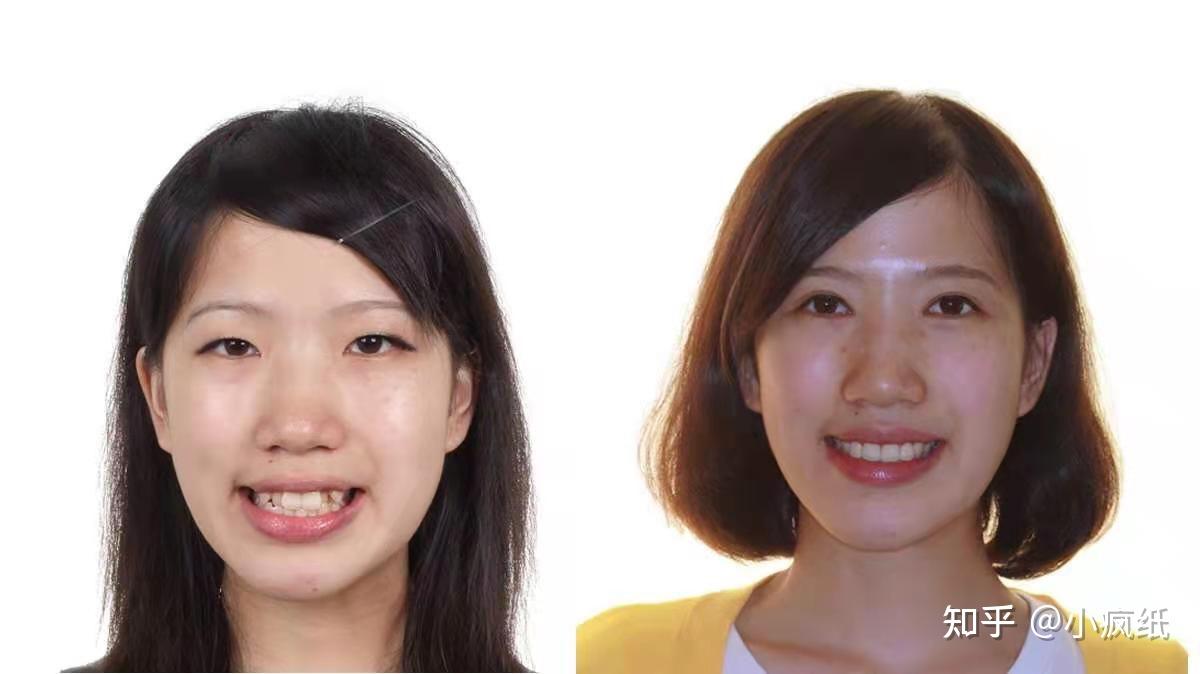 先看看案例2,整牙真的能改变脸型吗?