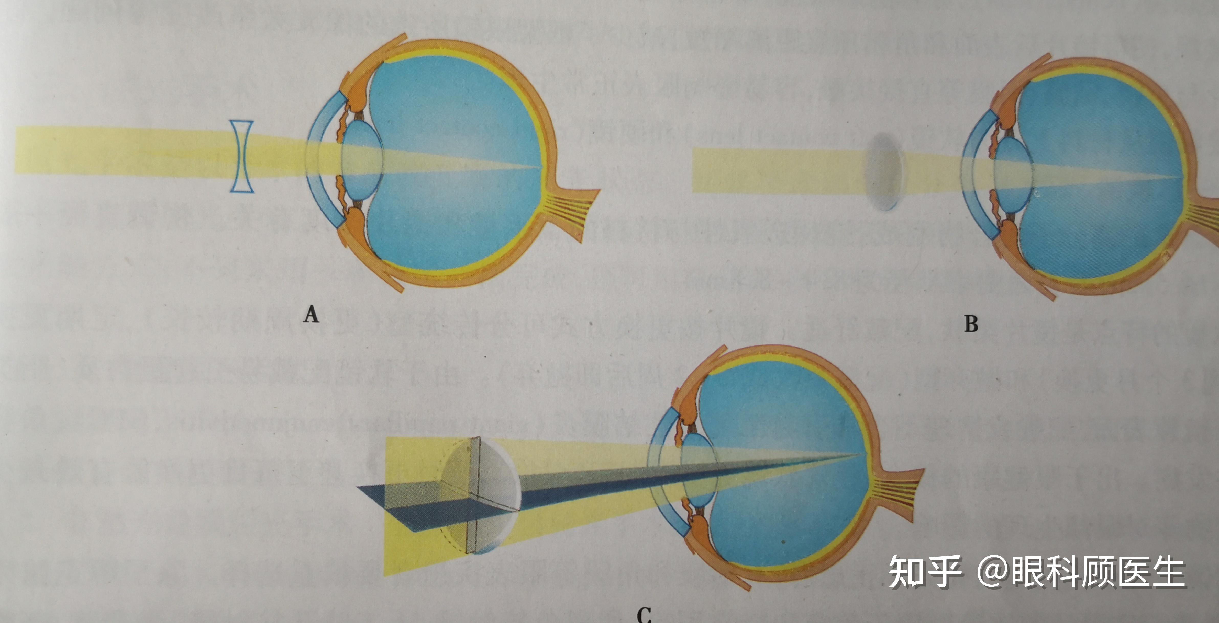 框架眼镜的球镜用于矫正球性屈光不正,即正球镜用于矫正单纯远视,负球