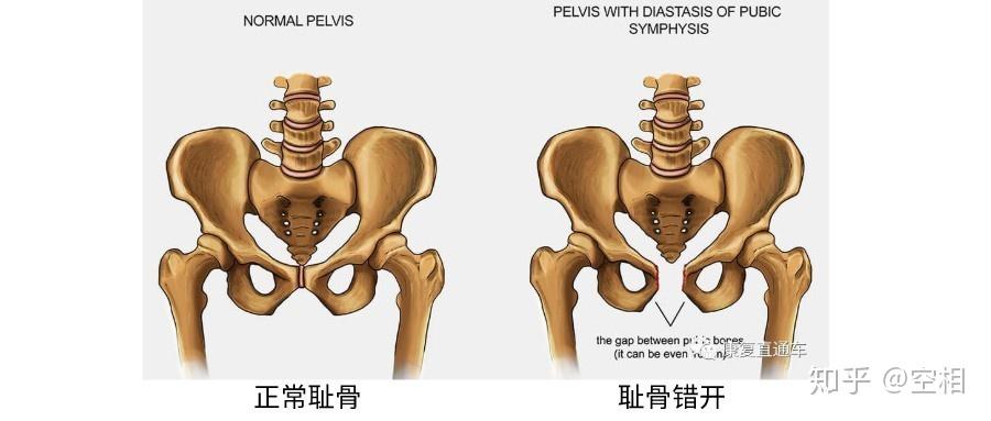 01但是在生完孩子之后,骨盆和耻骨还处于开合的状态中,不会自然而然的