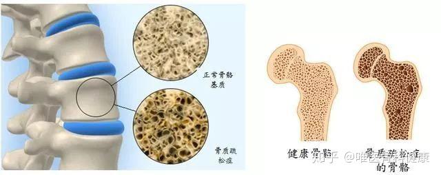加上老年人新陈代谢率降低,骨质中钙磷的排出增多,就会使骨质发生脱钙