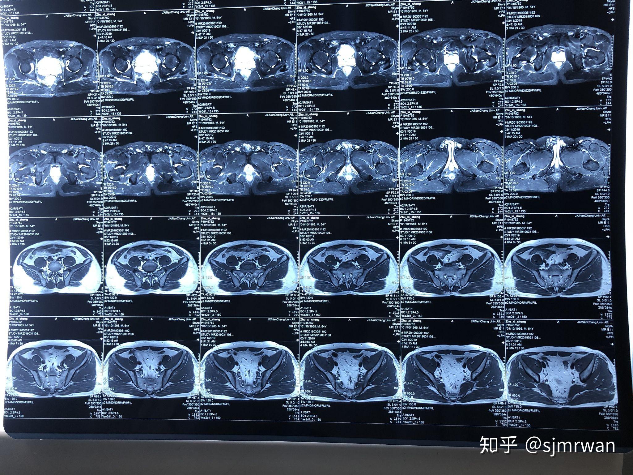 低位直肠isr一例