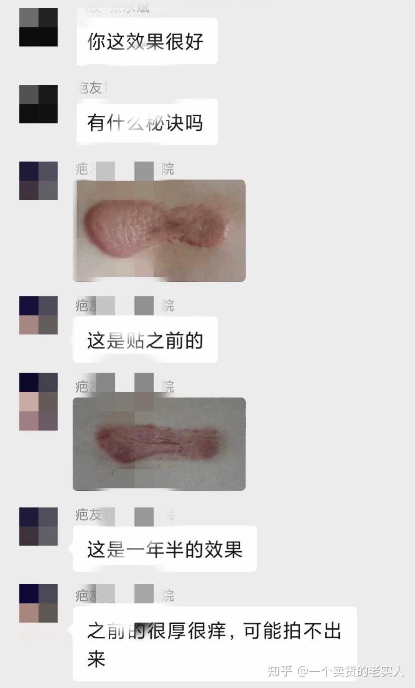 分享胸前长疤痕疙瘩