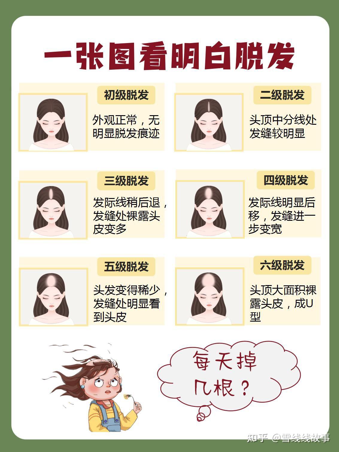 脱发等级 真人对照图图片