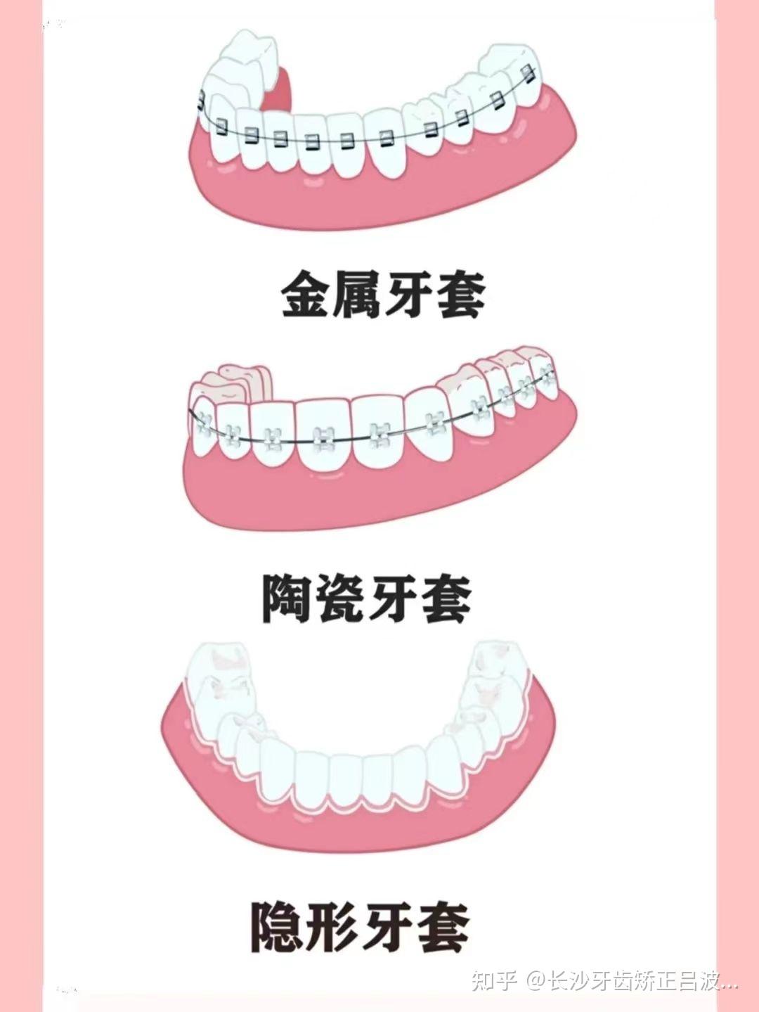 根管治疗和种植牙如何选择牙套？五种牙冠材料的详细分析 - 知乎