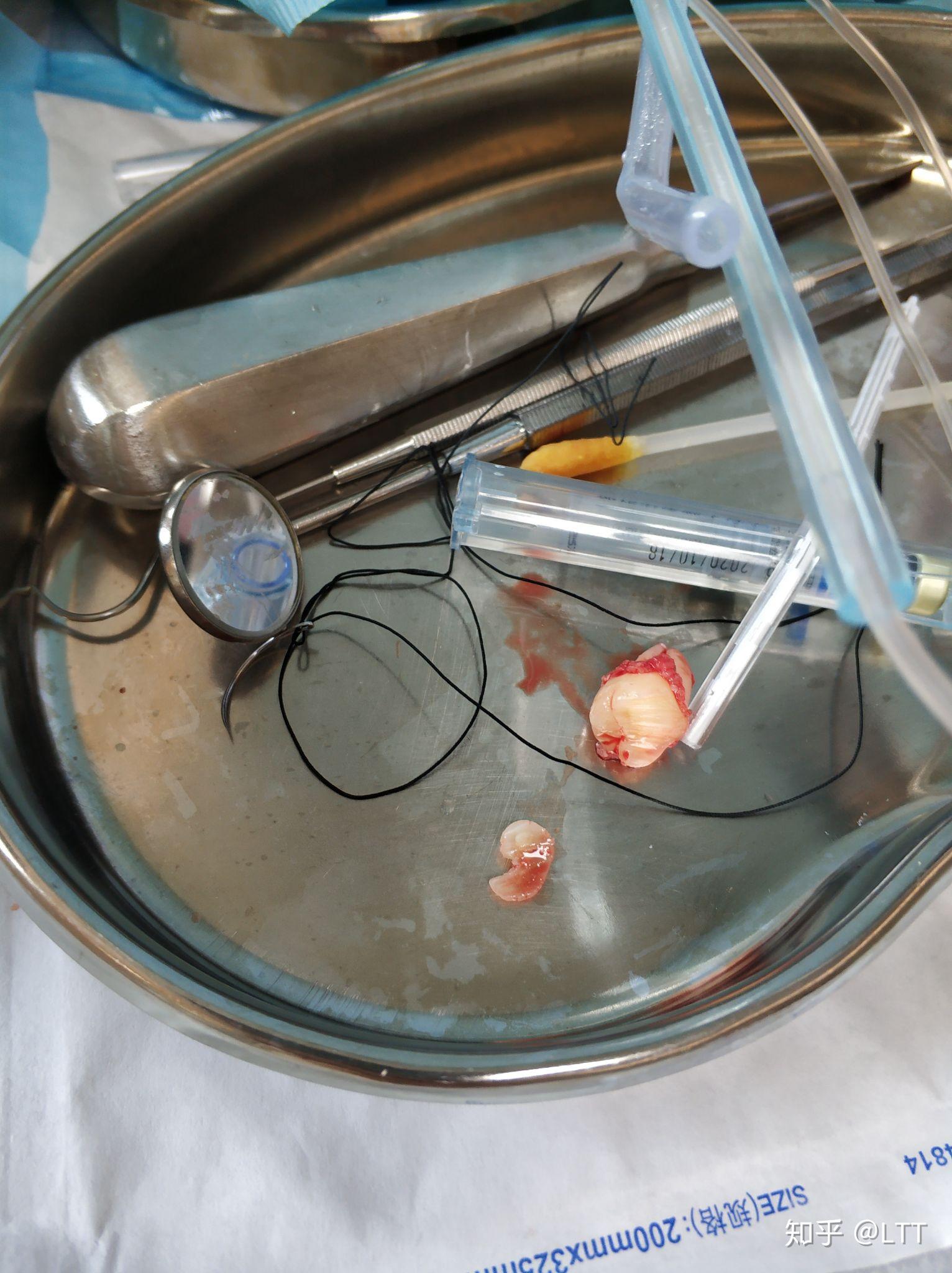 武大口腔拔智齿的体验