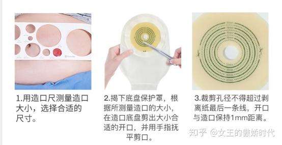 皓程提高造口人的生活质量 - 知乎