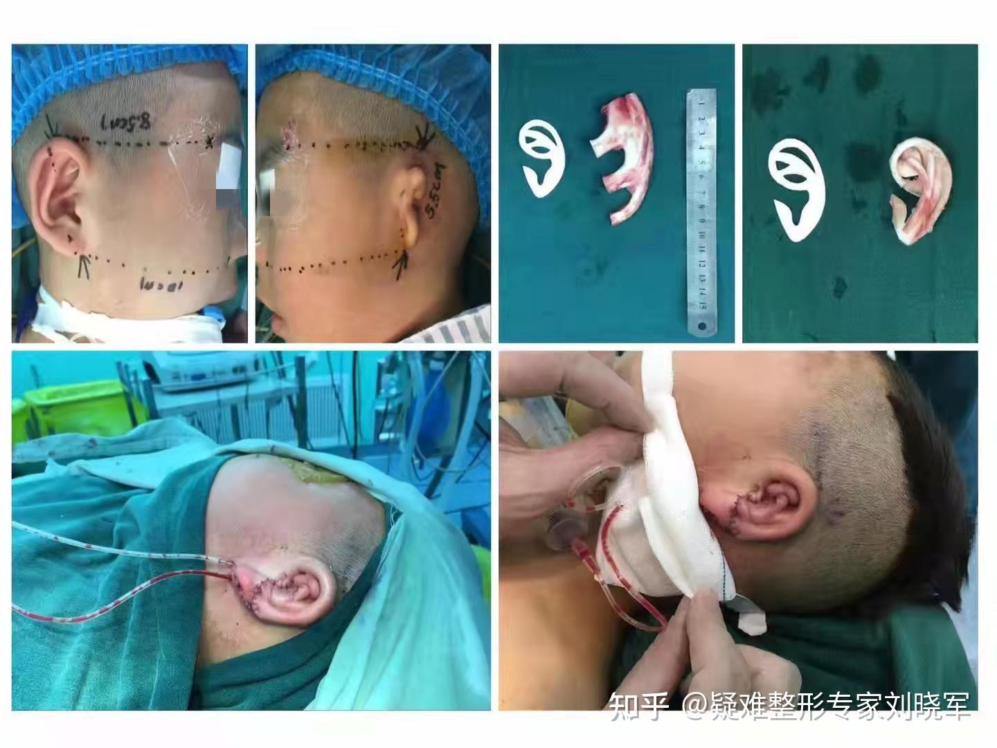 耳畸形修复再造的耳朵和真耳朵有什么区别