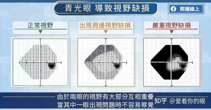 高眼压,杯盘比增大与青光眼的关系,以及近视要不要降眼压,一次说清