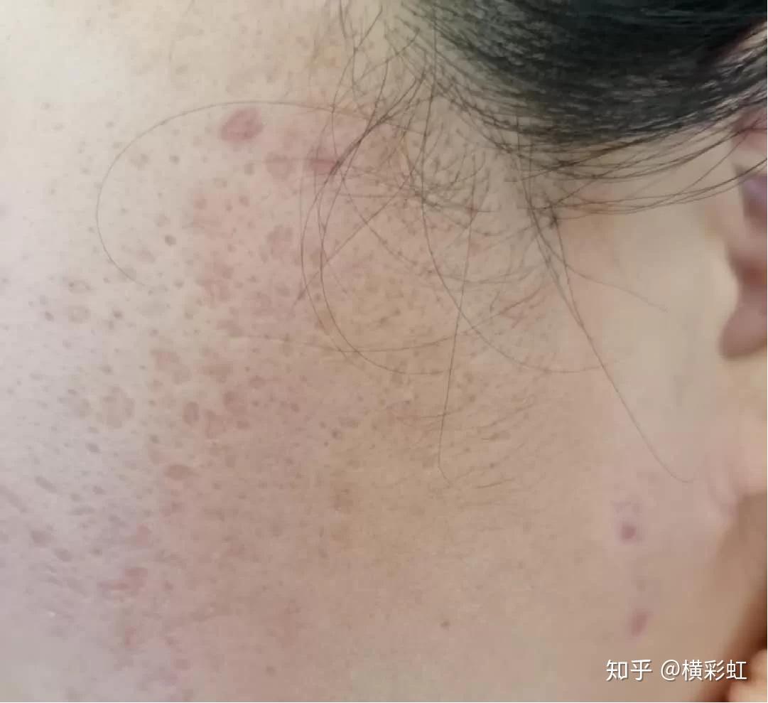 痘印自然消除要多久? - 知乎