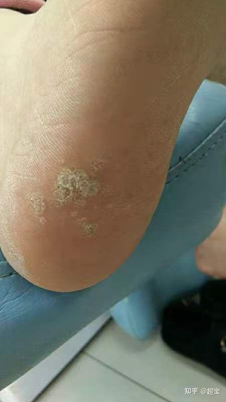 脚底人乳头瘤病毒图片图片
