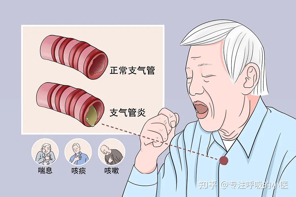 田凤主任教你辨别急性支气管炎/慢性支气管炎 - 知乎