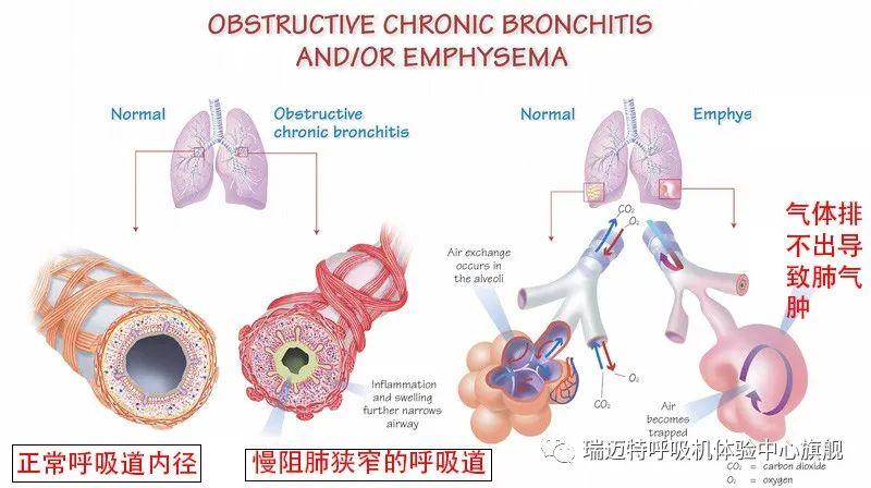 肺气肿的发病机制图片