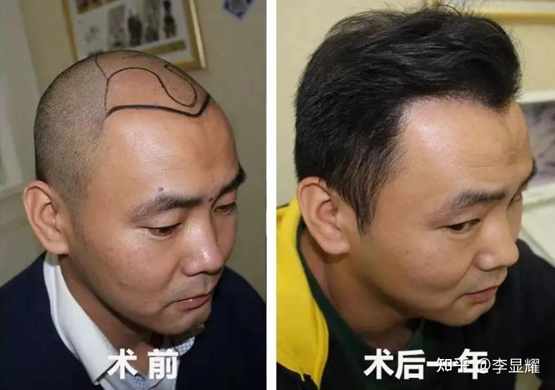 植发手术后可能还会遇哪些问题