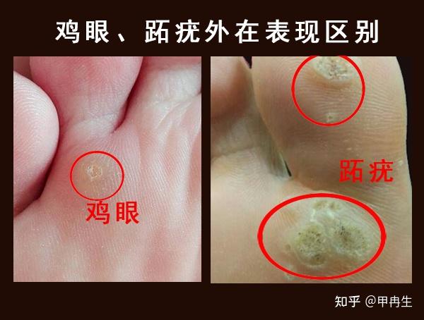 脚上小疙瘩长到“菜花”状,是跖疣? - 知乎