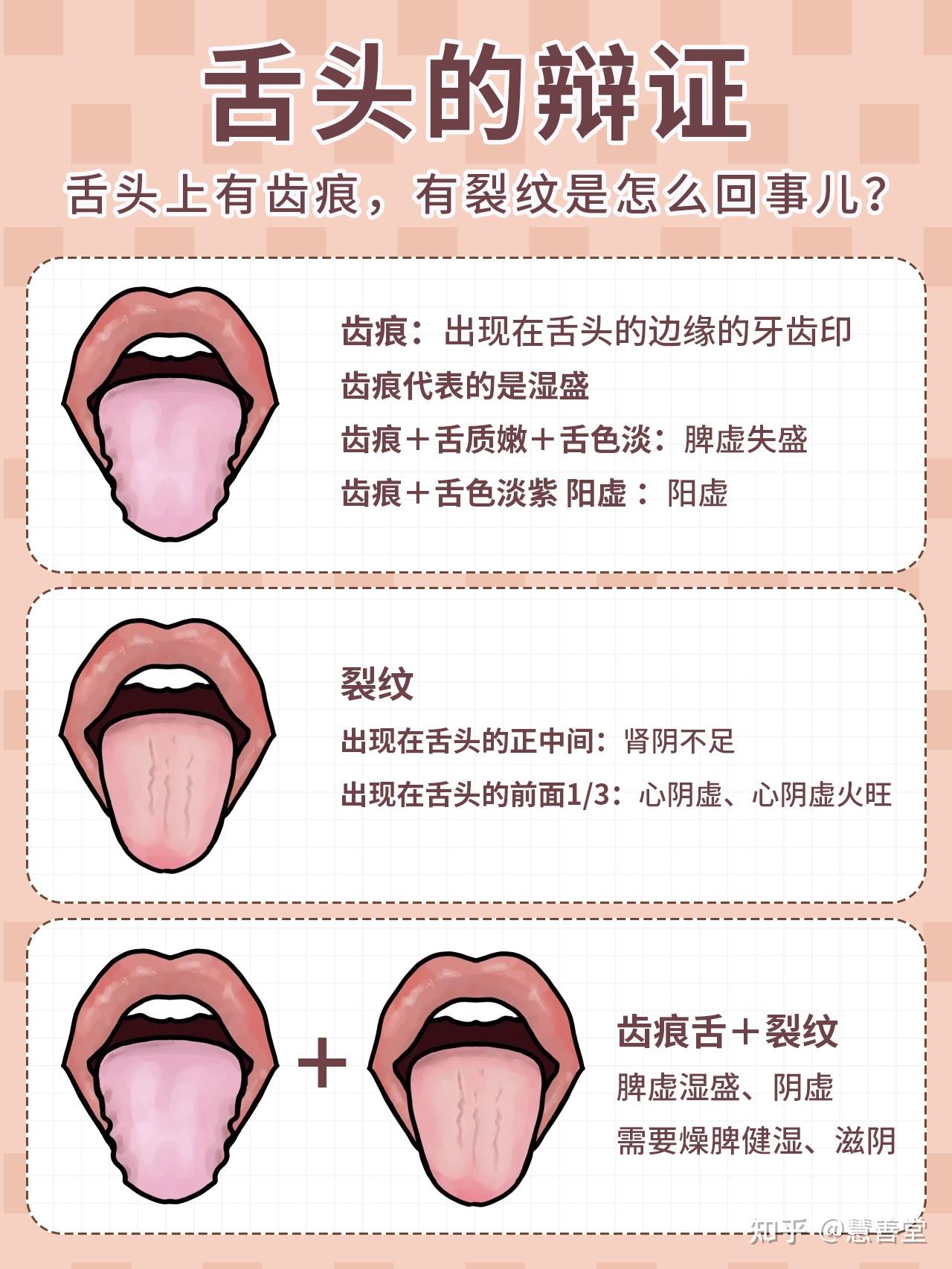 裂纹舌、齿痕舌、胖大舌分别代表了什么？ - 知乎