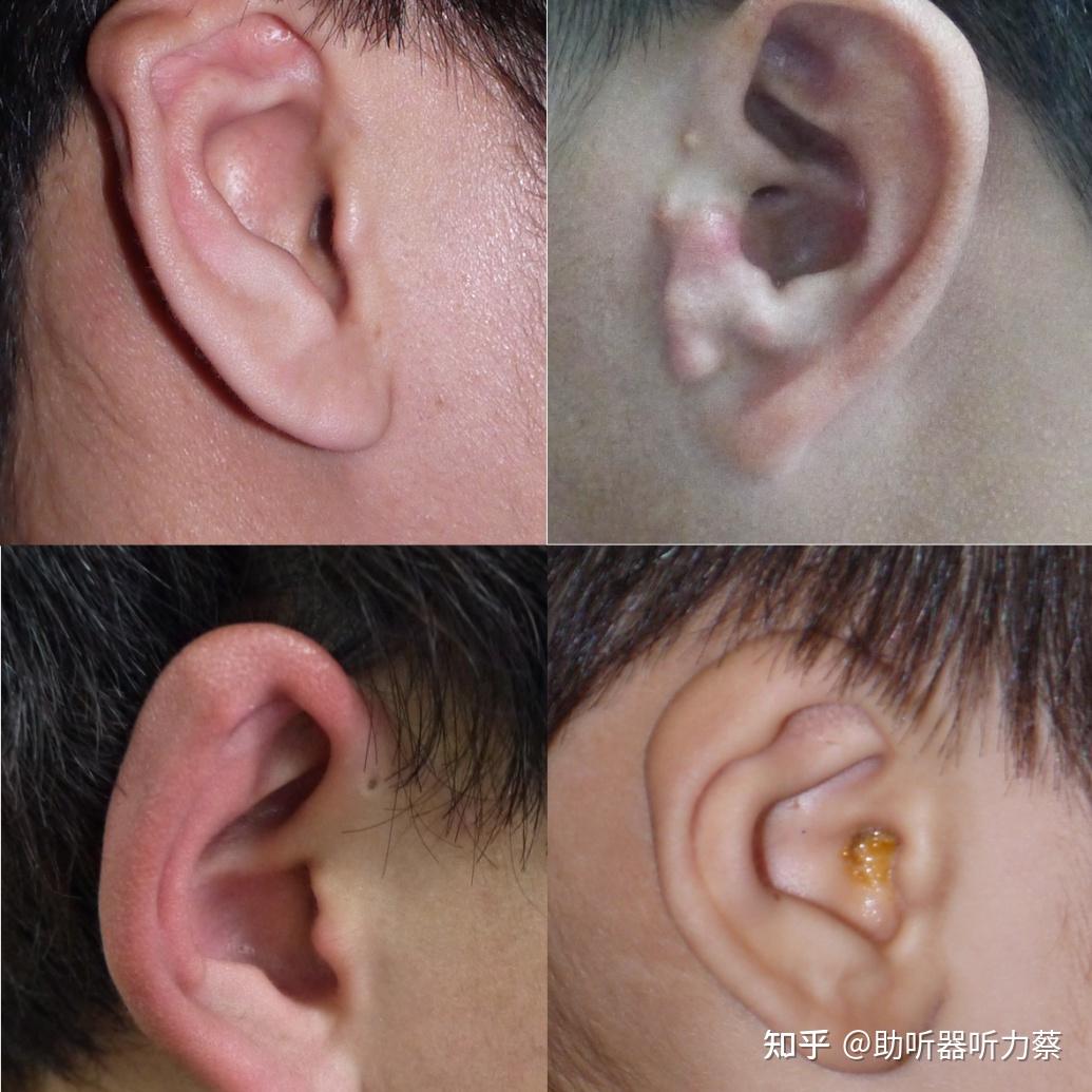 先天性小耳畸形的听力干预