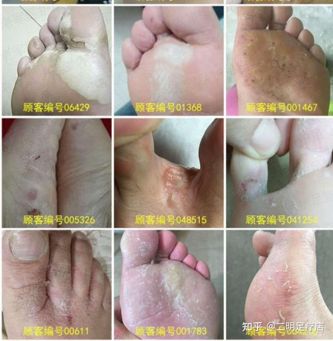 脚气粉 - 知乎