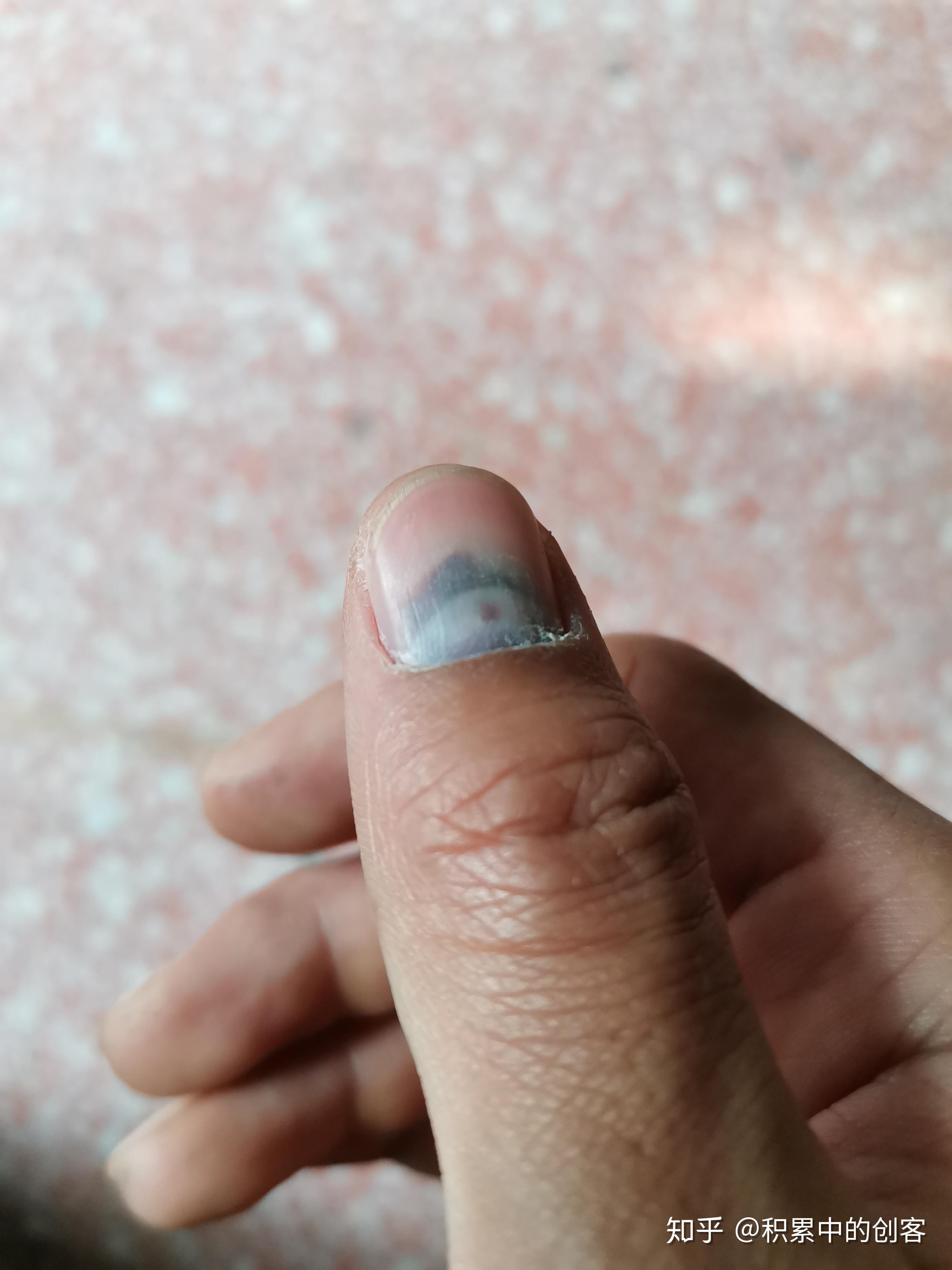 指甲挤受伤 - 知乎