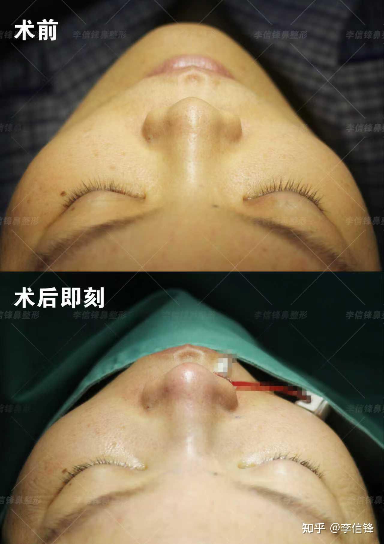 鼻子短、朝天漏鼻孔,鼻基底凹陷改善,术后即刻案例~ - 知乎