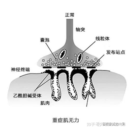 眼皮耷拉抬不起小心是重症肌無力作祟