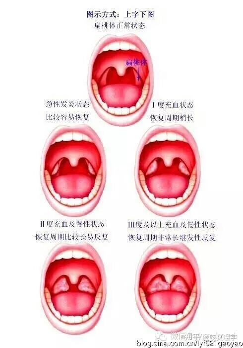 全篇干货:记录腺样体肥大diy治疗