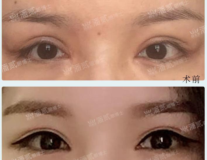 状态下眼睛的形与神自然双眼皮显年轻和善柔和宽深假双眼皮显凶显老