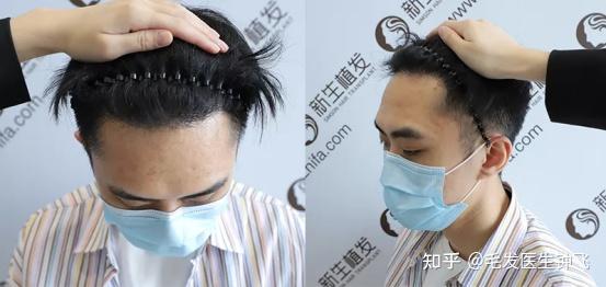 新生植发技术之3d植发技术