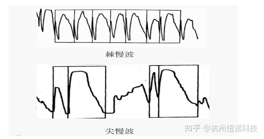 异常脑电图尖波尖慢波图片