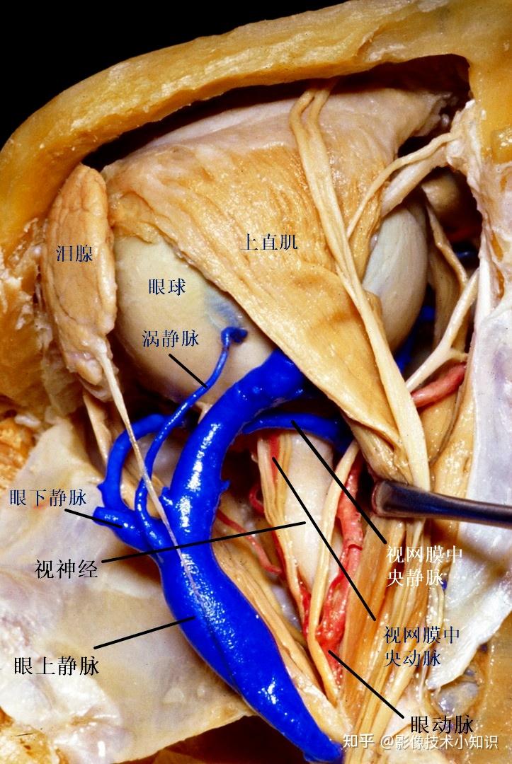 眼肌ct解剖图片