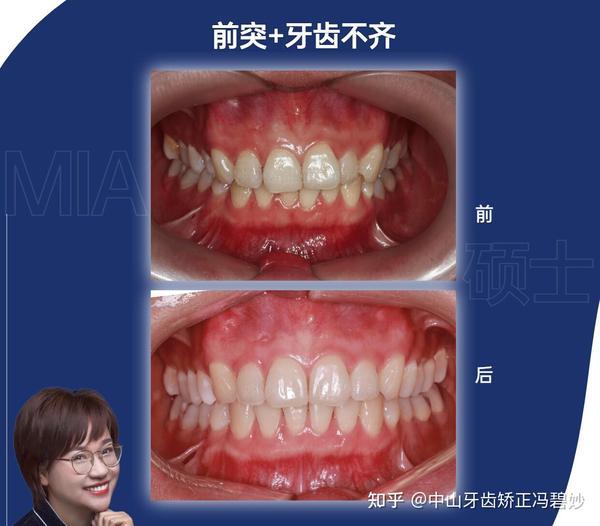 #中山牙齿矫正#中山整牙|面部微笑美学之笑线。 - 知乎