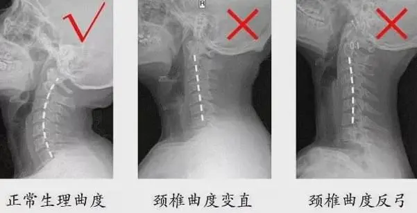 由于长期坐姿,睡姿不良和颈椎退变时,颈椎的前凸可逐渐消失,甚至可变