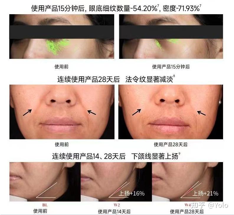 【皮肤科医生】从专业角度看,消除法令纹最快最有效的方法是什么? - 知乎