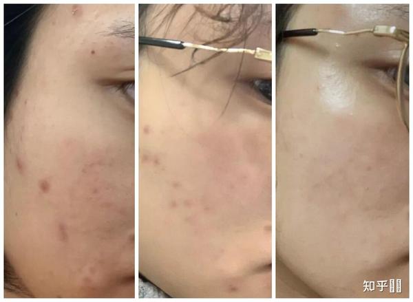 痘印自然消除需要多久？ - 知乎