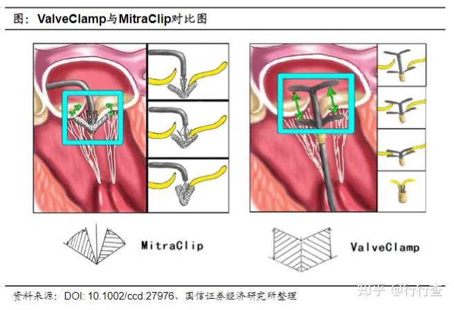 浅析人工心脏瓣膜的发展