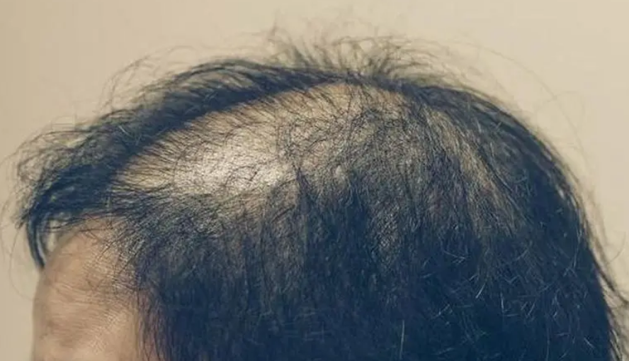 脱发症状经过缓慢,可呈阶段性,时轻时重,数年后可致头顶或两鬓毛发