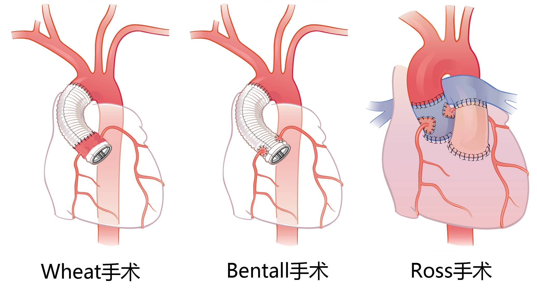 frey手术图片