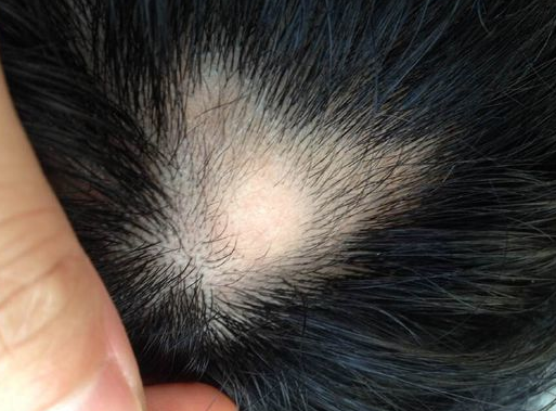 斑秃知道这几点原因,很快就能治好长出头发