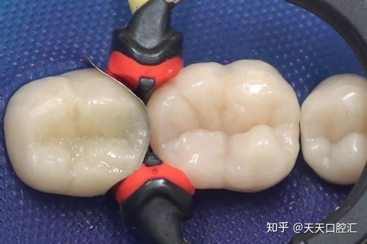 主流补牙材料大起底总有一款适合你