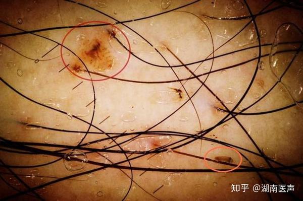 洁身自好却染上阴虱病？76岁爹爹下身瘙痒难耐，别忽略这个不良习惯