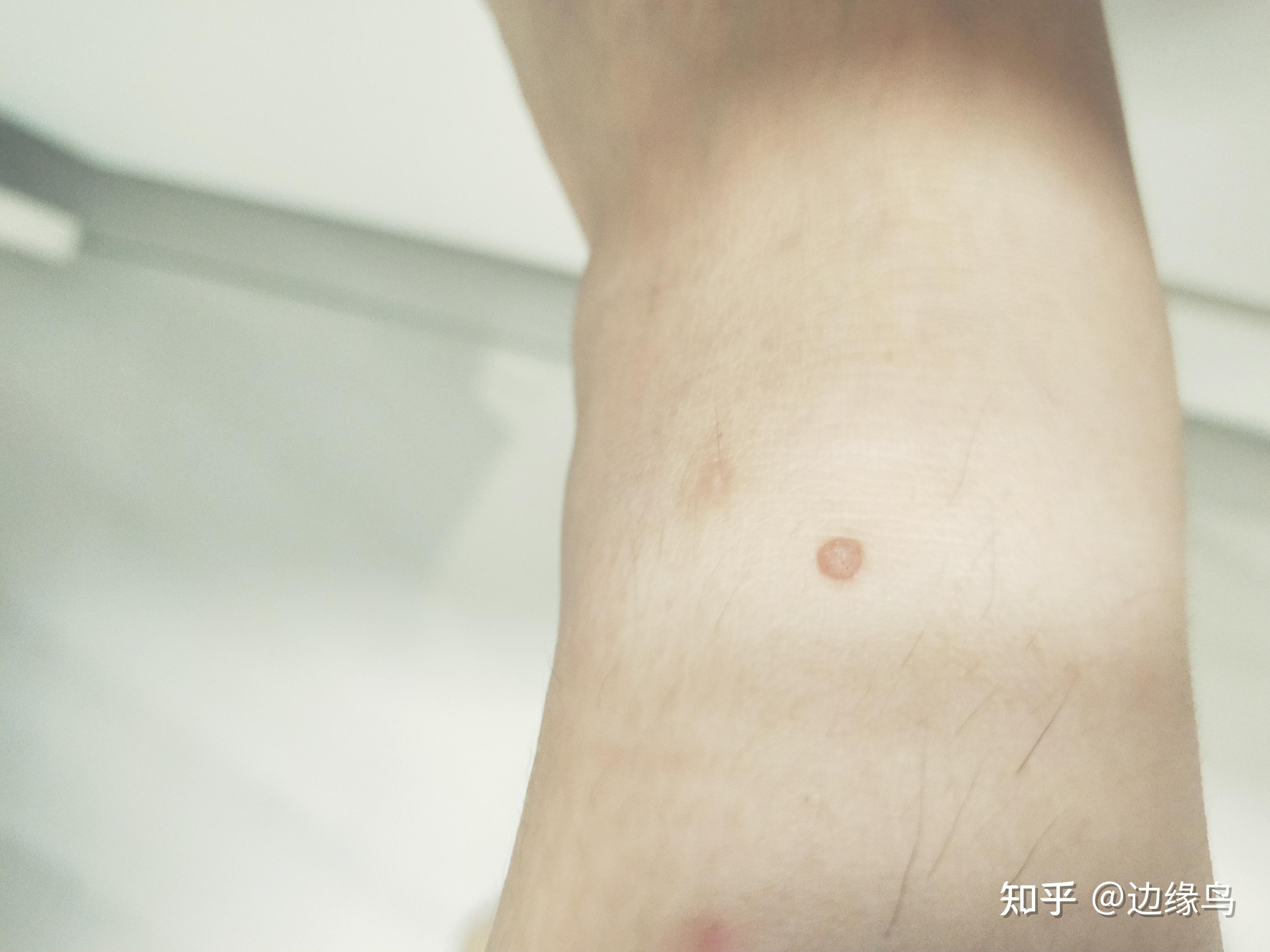 如何去除扁平疣 - 知乎