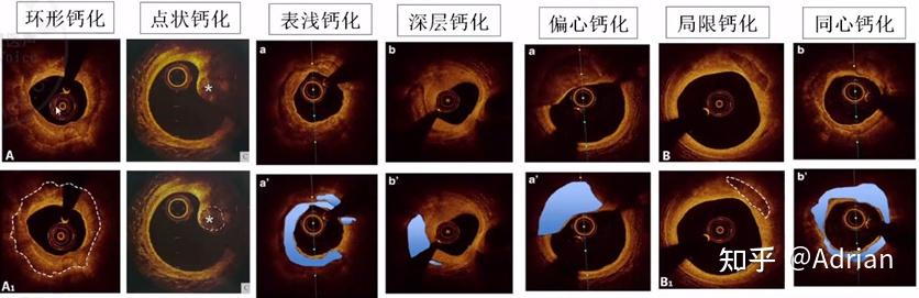 冠脉影像学CT、造影CAG、血管内超声IVUS、光学相干断层成像术OCT的比较 - 知乎