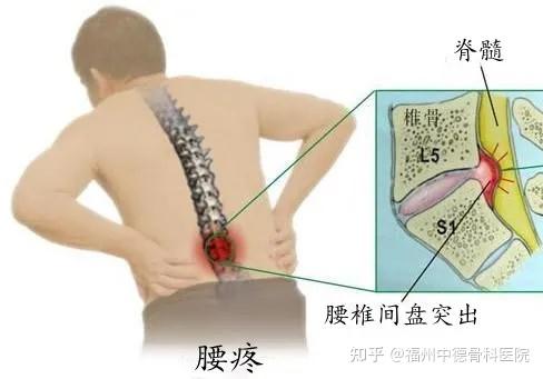 女性腰痛部位图解图片