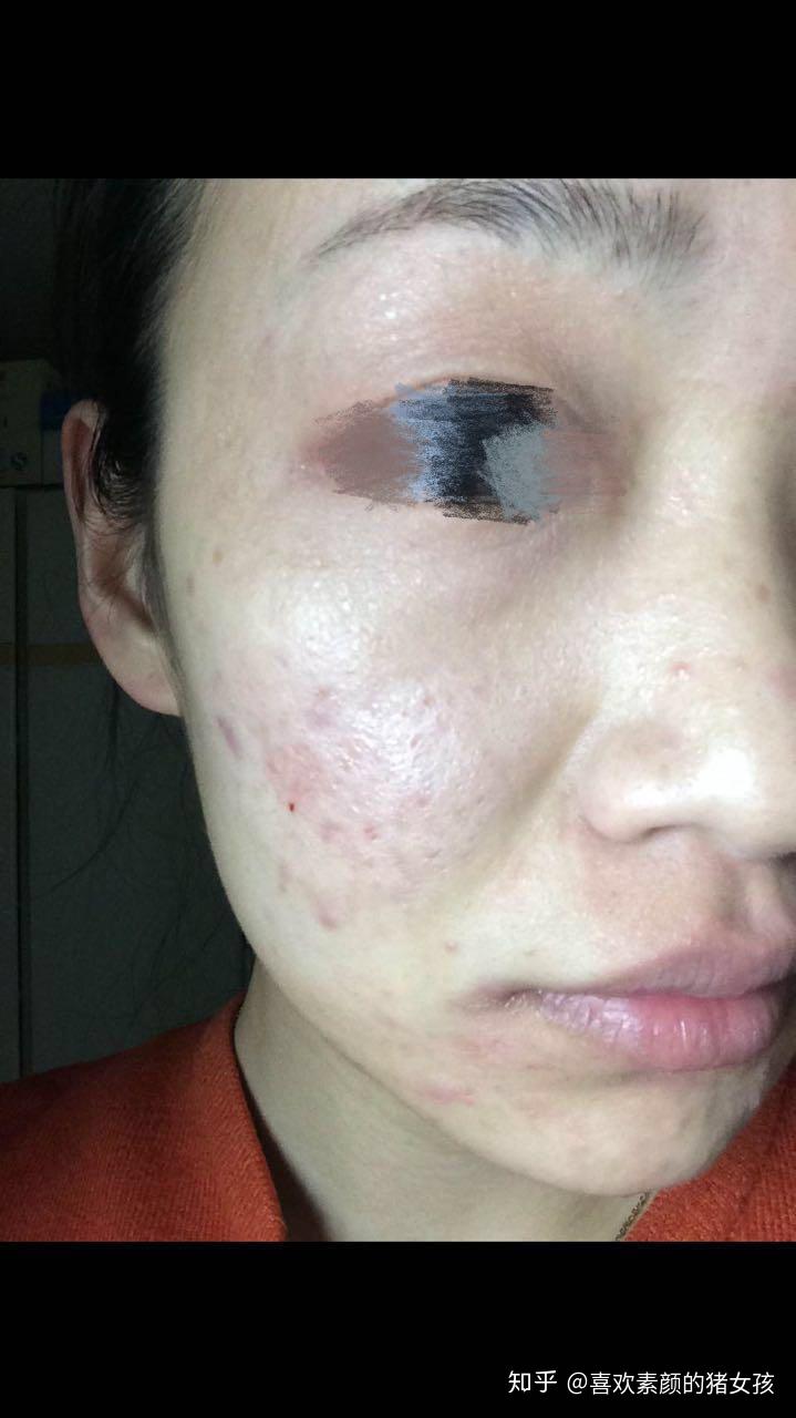 皮膚敏感怎么修復